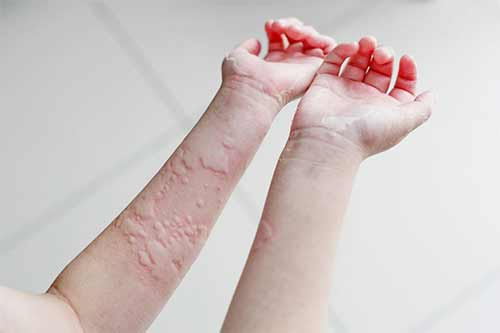 کهیر (Urticaria)