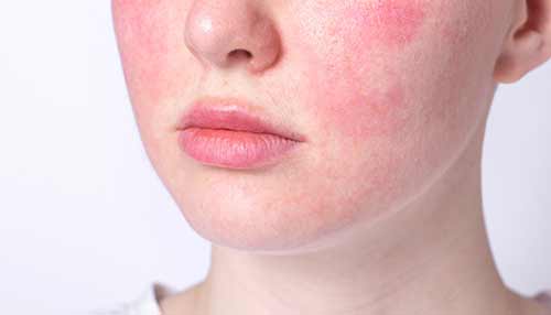 روزاسه (Rosacea)